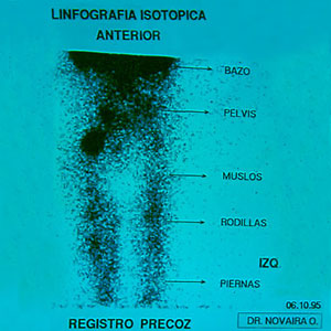 Linfografa dinmica o linfocentellografa