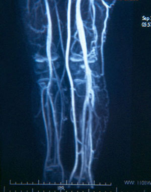 Angioresonancia con mayor irrigacin en pierna izquierda